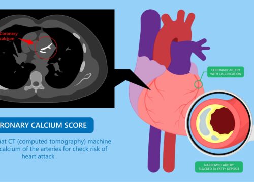 Coronary Calcium Score image