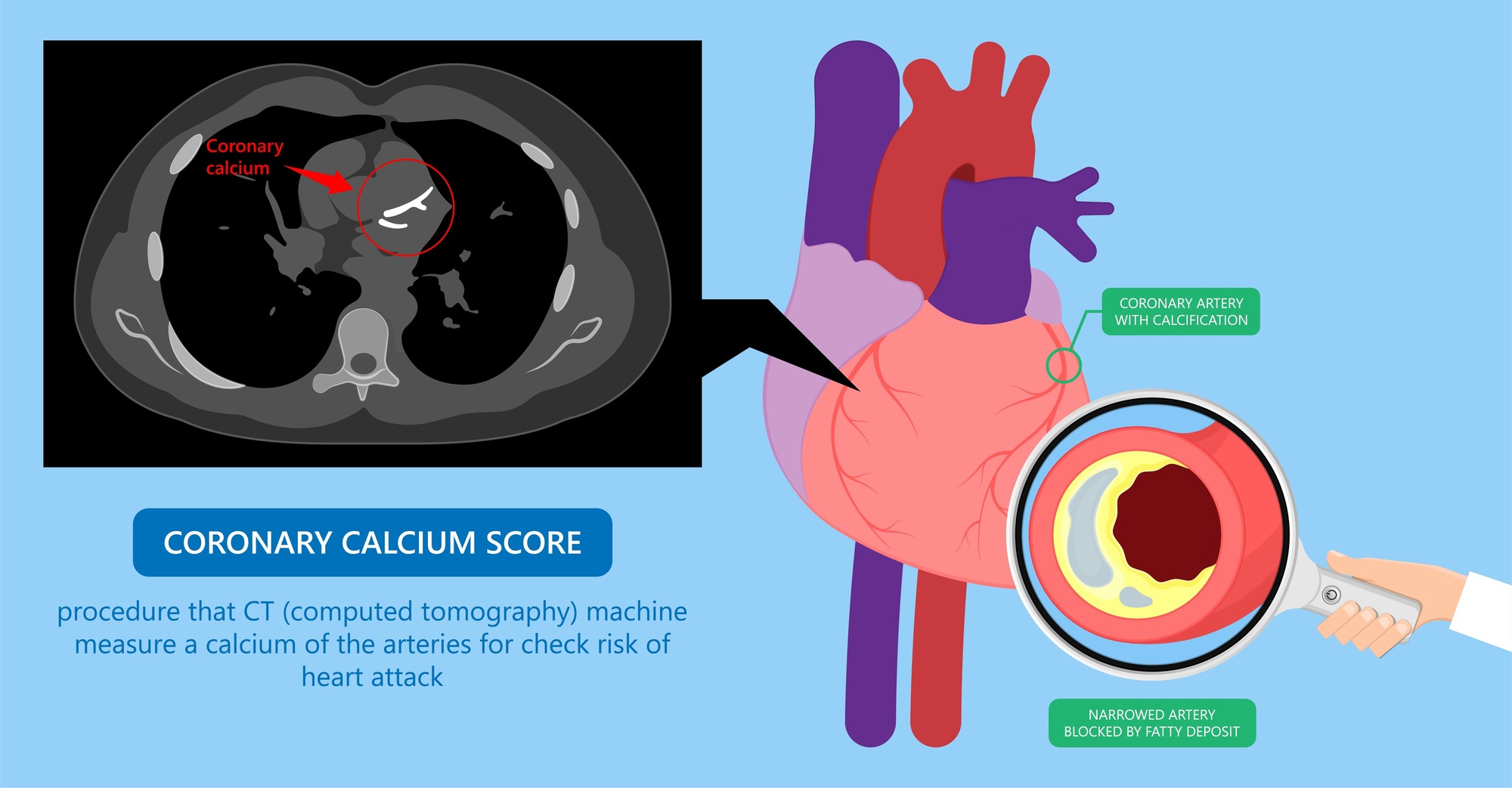 Coronary Artery Calcium Scan