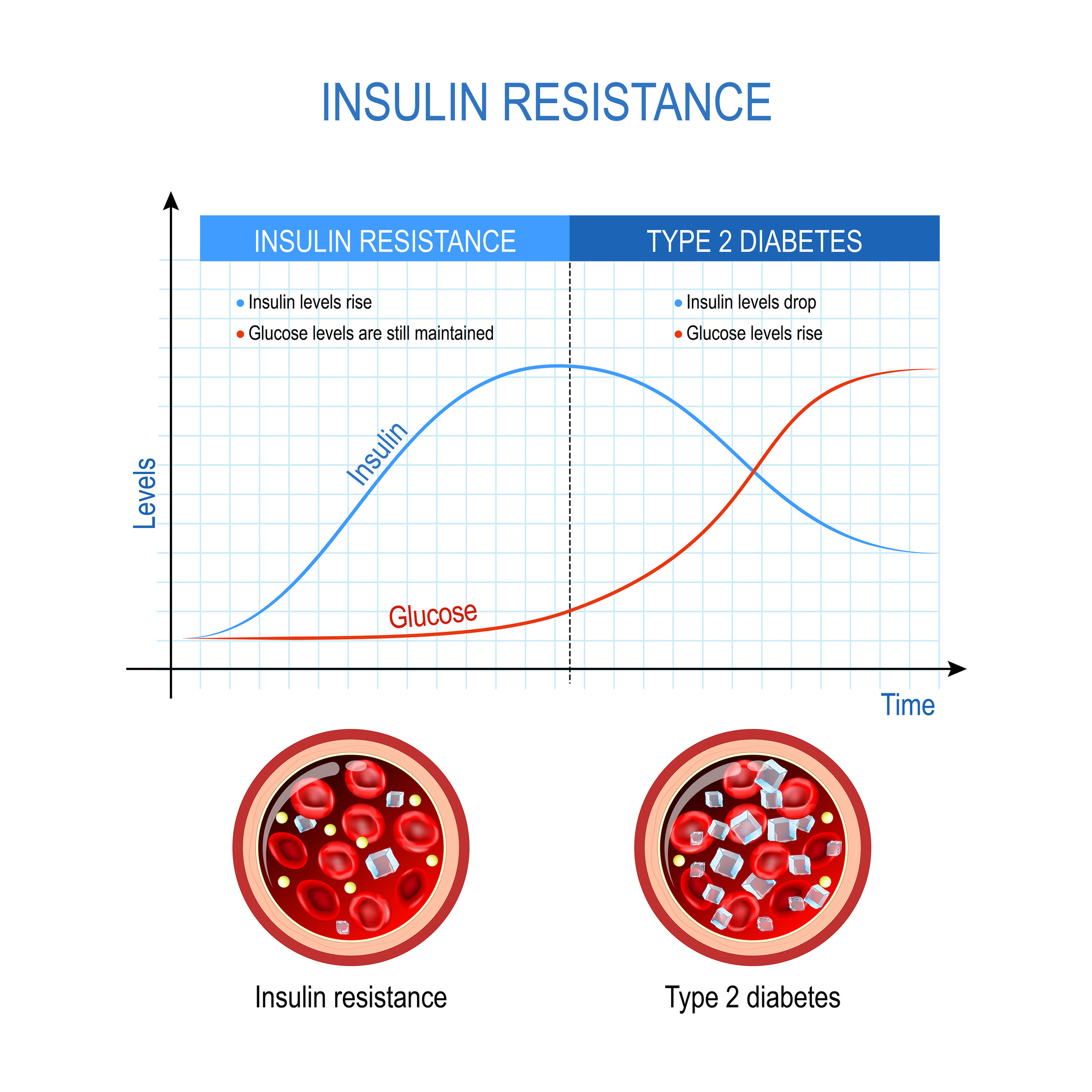 Chart showing the differences between insulin resistance and type 2 diabetes
