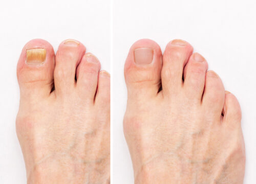 Photo of feet with toenail fungus